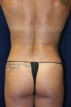 Abdominal Etching : Case 2 - After