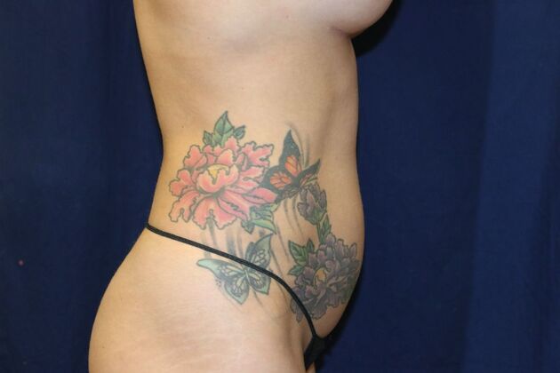 Abdominal Etching : Case 2 - Before