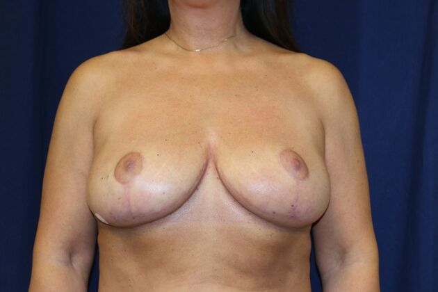 Breast Lift*: Case 1 - After
