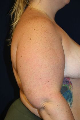 Arm Lift*/Arm Sculpting: Case 16 - Before