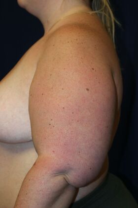 Arm Lift*/Arm Sculpting: Case 16 - Before