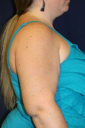 Arm Lift*/Arm Sculpting: Case 16 - After