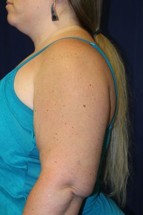 Arm Lift*/Arm Sculpting: Case 16 - After