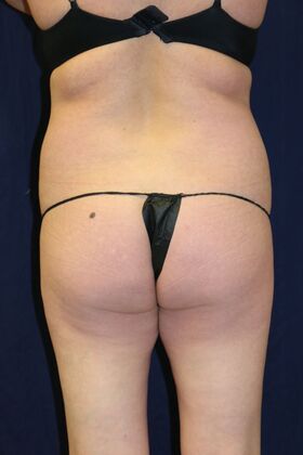 Brazilian Butt Lift : Case 13 - Before