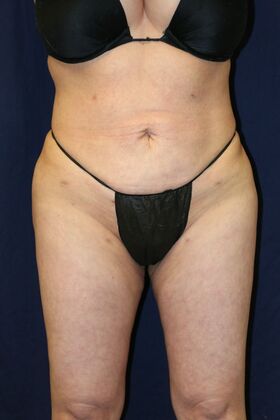 Brazilian Butt Lift : Case 13 - After