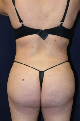 Brazilian Butt Lift : Case 13 - After