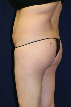 Brazilian Butt Lift : Case 13 - Before