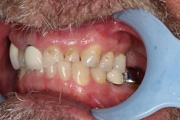Full Mouth Reconstruction: Case 9 - Before