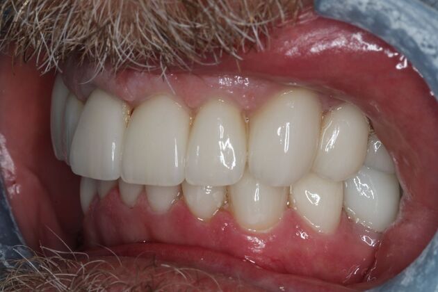 Full Mouth Reconstruction: Case 9 - After