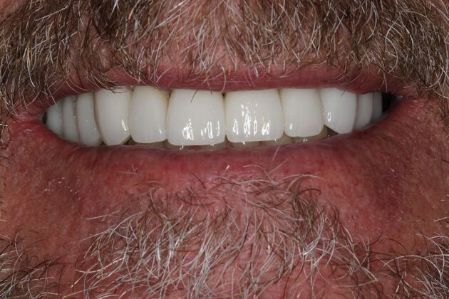 Full Mouth Reconstruction Case 9 - After