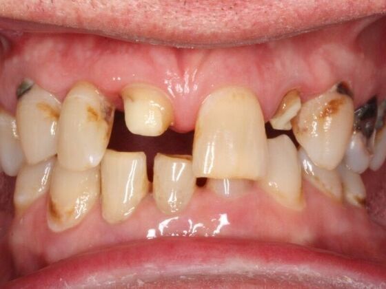 Porcelain Crowns and Veneers: Case 2 - Before