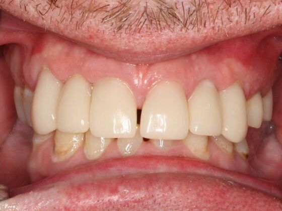 Porcelain Crowns and Veneers: Case 2 - After