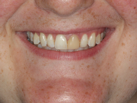 Porcelain Crowns and Veneers: Case 3 - After