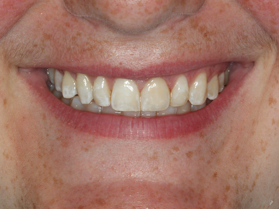 Porcelain Crowns and Veneers: Case 3 - Before