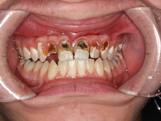 Porcelain Crowns and Veneers: Case 4 - Before