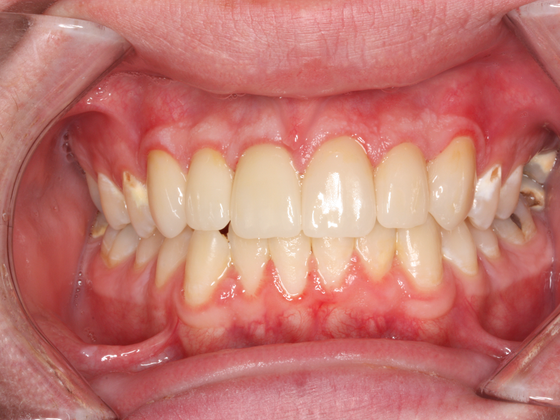 Porcelain Crowns and Veneers: Case 4 - After