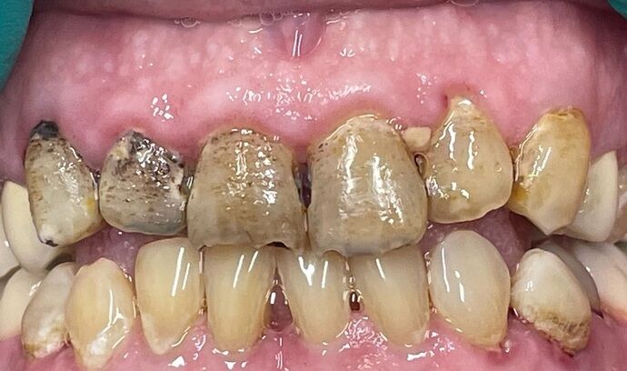 Porcelain Crowns and Veneers: Case 6 - Before