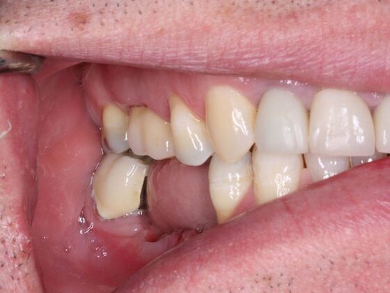 Dental Implants Case 1 - Before