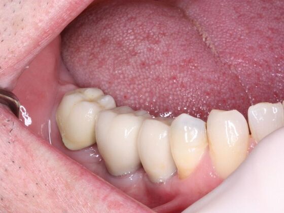 Dental Implants Case 1 - After