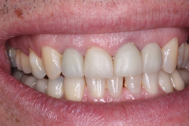 Dental Implants: Case 1 - After