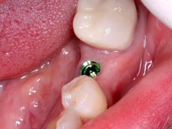 Dental Implants Case 2 - Before