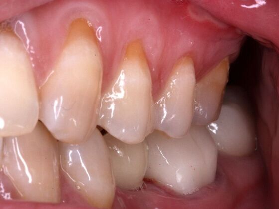 Dental Implants Case 2 - After