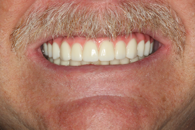 Dental Implants Case 4