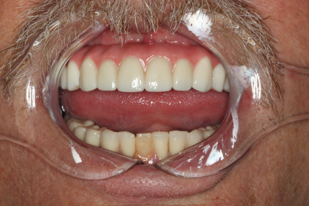 Dental Implants: Case 4 - After