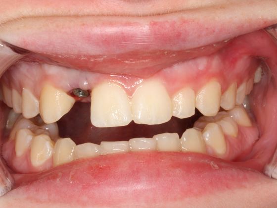 Dental Implants Case 5 - Before