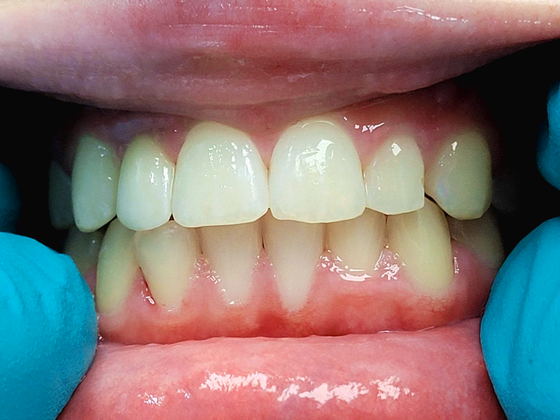 Dental Implants Case 5 - After