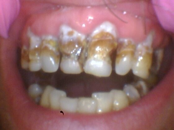 Dental Implants Case 6 - Teeth in a Day - Before