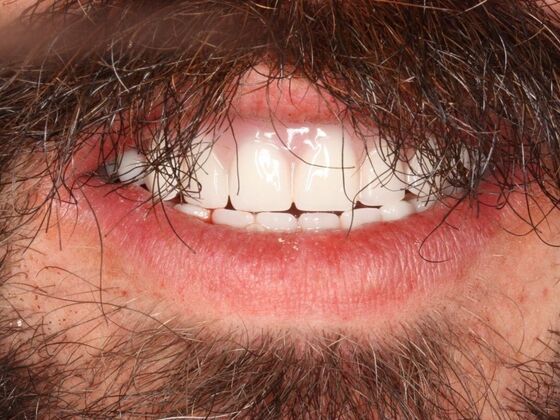 Dental Implants Case 6 - Teeth in a Day - After