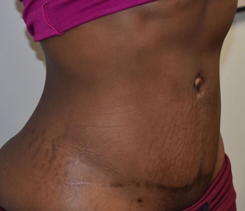 Tummy Tuck (Abdominoplasty): Case 481 - After