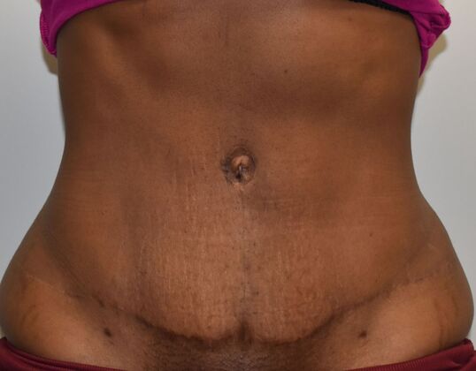 Tummy Tuck (Abdominoplasty): Case 481 - After
