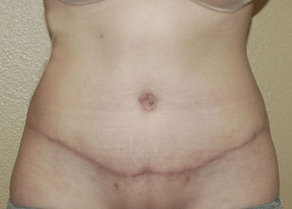 Tummy Tuck (Abdominoplasty): Case 371 - After