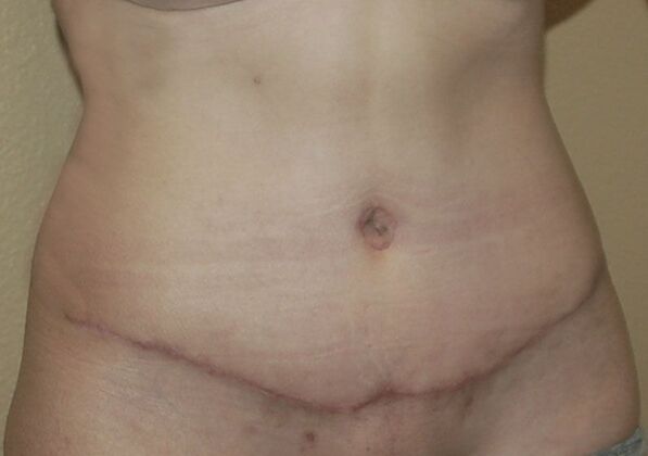 Tummy Tuck (Abdominoplasty): Case 371 - After