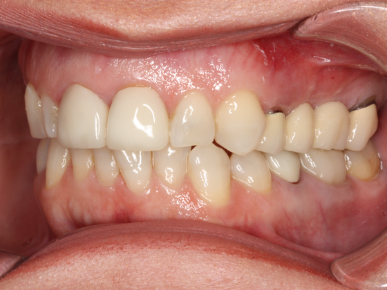 Porcelain Crowns and Veneers: Case 8 - Before