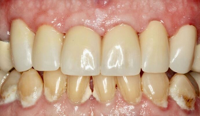Porcelain Crowns and Veneers: Case 6 - After