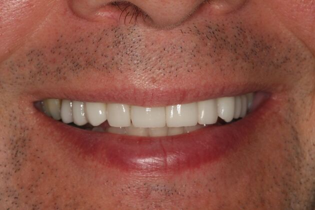 Porcelain Veneers: Case 30 - After