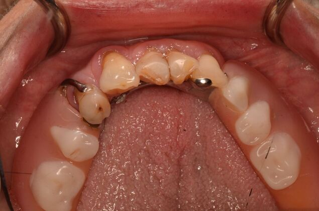 Missing lower teeth and broken lower replaced by four implants and a hybrid  Case 1 - Before