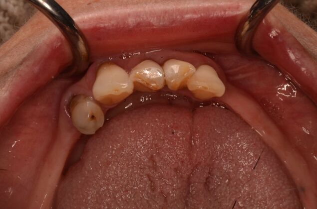 Missing lower teeth and broken lower replaced by four implants and a hybrid : Case 1 - Before
