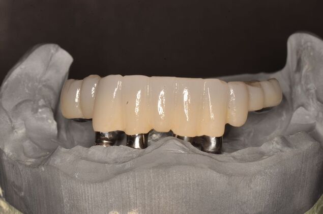 Missing lower teeth and broken lower replaced by four implants and a hybrid : Case 1 - After