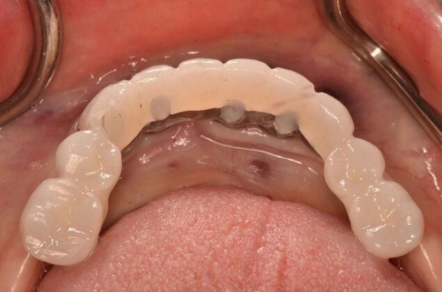 Missing lower teeth and broken lower replaced by four implants and a hybrid Case