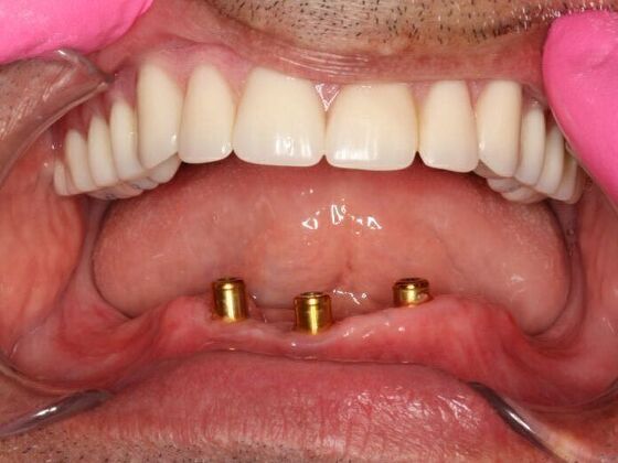 Dental Implants Case 7 - Before