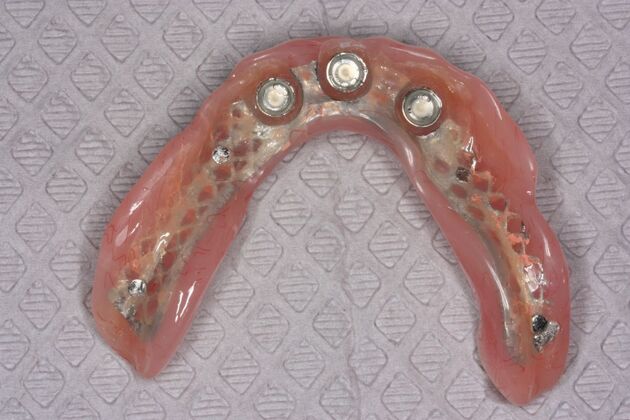 Dental Implants: Case 7 - After