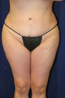 Brazilian Butt Lift : Case 12 - After