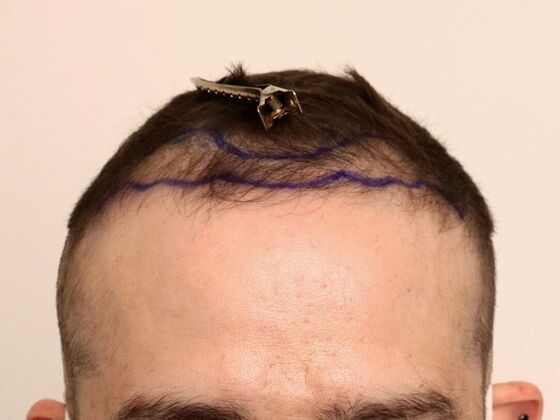 Male Before And After Hair Transplant Photos Frontal FUE (6) - Before