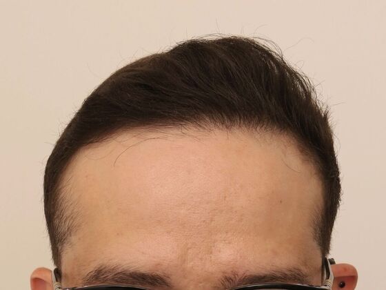 Male Before And After Hair Transplant Photos Frontal FUE (6) - After