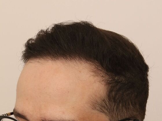 Hair Transplant - Male: Frontal FUE - Case 29 - After FUE hair transplant