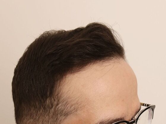 Hair Transplant - Male: Frontal FUE - Case 29 - After FUE hair transplant